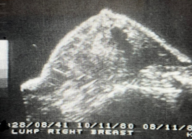 1981 ultrasound image labeled "Lump right breast," showing the original whole-breast water-bath scan from the case described.